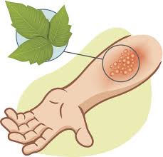 Do you have little blister looking bumps? Common Summer Skin Rashes Harvard Health