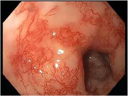 Image result for Radiation Colitis