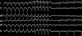 Image result for Ventricular Fibrillation Management in the Adult