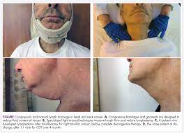 The most common type of skin cancer, basal cell carcinoma is more common on the head and neck than on other. Prehabilitation For Lymphedema In Head And Neck Cancer Patients At A Community Cancer Center Mdedge Hematology And Oncology