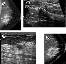 Image result for Breast Cancer Staging