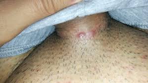 Here are photos of infected ingrown hair follicles, treatment and removal. What Are These Sexual Health Forums Patient