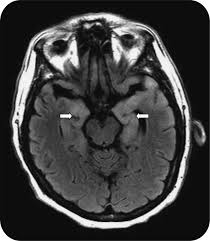 Image result for Neurosyphilis