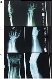 Scielo Brasil Ultrasound Treatment For Accelerating Fracture Healing Of The Distal Radius A Control Study Ultrasound Treatment For Accelerating Fracture Healing Of The Distal Radius A Control Study