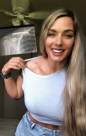 Hey guys! Little health update 🤓 Two weeks out from collarbone surgery ! I  am finally able to take my arm out of the sling and move my arm around  again. Though