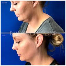 Beth Myrick, ARNP Nurse Injector