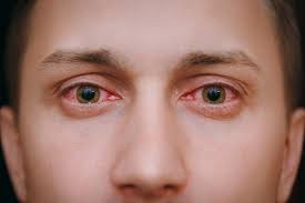Image result for Conjunctivitis Resources