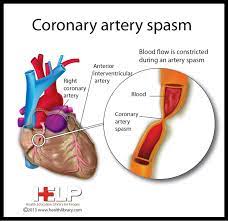 Coronary Artery Spasm Coronary Arteries Heart Disease Symptoms Heart Facts