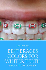 I have had braces for about a year and a half. How To Whiten Teeth With Braces Arxiusarquitectura