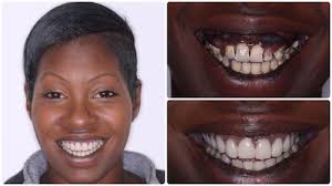 Well, you can try something like typing cheap dental implants and it is almost difficult to find real information about this topic. Low Cost Dental Implant Cosmetic Dentist Toronto Dental Clinic Cosmetic Dentistry Toronto Dental Implants Toronto Invisalign Toronto Emergency Dentist Toronto Teeth Whitening