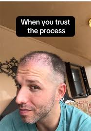 Zigzag Hairline: The New Trend in Hair Transplants