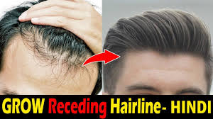 When this mature hairline begins is entirely up to your genetics. How To Stop Hairline Receding Hair Loss Naturally Receding Hairline Problem Men Asad Ansari Youtube