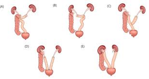 Image result for Urelytrum