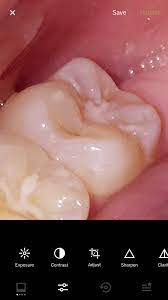 Dental caries (cavities) can be defined as holes in the tooth outer layers which are known as the dentin and enamel. How Do I Know If I Have A Cavity Reddit