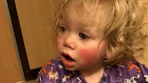 Meet the British Toddler Who Is Allergic to Sunlight