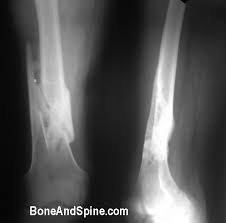 The investigators also noted eswt led to good results, with a relatively short time of rest from the patients' activities and a return to dancing without pain. Fracture Healing Stages Types And Factors Affecting Bone Repair Bone And Spine