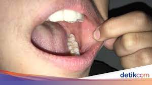 Dalam beberapa kasus, jerawat di sekitar mulut sama sekali bukan jerawat. Gejala Baru Covid 19 Studi Temukan Ruam Mulut Di Pasien Corona