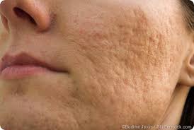 5 causes de boules sous la peau. Kystes Et Marquage