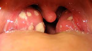 Rash And Swollen Lymph Nodes Causes Photos And Treatment