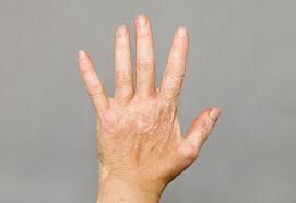 Image result for Vitiligo