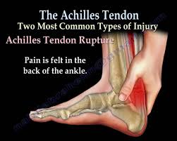 Achilles Tendon Rupture Tear Tendonitis Everything You Need To Know Dr Nabil Ebraheim Youtube