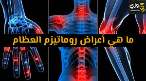 We did not find results for: Ø£Ù‡Ù… Ù…Ø§ Ù‡ÙŠ Ø£Ø¹Ø±Ø§Ø¶ Ø±ÙˆÙ…Ø§ØªÙŠØ²Ù… Ø§Ù„Ø¹Ø¸Ø§Ù… Youtube