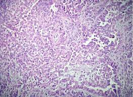 Malignant pleural mesothelioma (mpm) is an aggressive tumor linked to asbestos exposure. Peritoneal Biopsy Shows Malignant Mesothelioma Cells H E X 200 Download Scientific Diagram