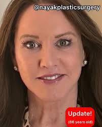 ☀️🌞 66 years old ,10 weeks after surgery! 👸💪 Tina lost 110 pounds over  the last 3 years. ⚡️💃 While she feels amazing and energized, her weight  loss accelerated her facial aging