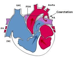Image result for Left Ventricular Outflow Obstruction