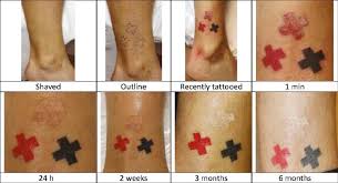 In fact, you really can't go wrong getting arm tattoos for men. Clinical Observation Of A Professional Tattooing Procedure And Evolutionary Study Of The Skin Damage Provoked