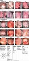 Image result for Friable Cervix