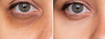 Ojeras oscuras, ¿cómo combatirlas? - Centro Médico Estético Ruiseñores