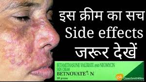 The Shoking Truth Of Betnovate N Cream Betnovate N Cream Review And Side Effects Youtube Serious side effects are rare. the shoking truth of betnovate n cream