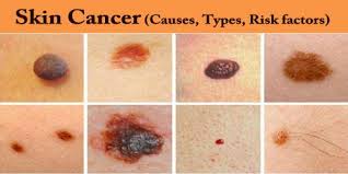You may not associate breast cancer with redness or a skin rash, but in the case of inflammatory breast cancer (ibc), a rash is an early symptom.this is an aggressive form of breast cancer that. Skin Cancer Causes Types Risk Factors Assignment Point