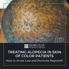 Image result for Alopecia