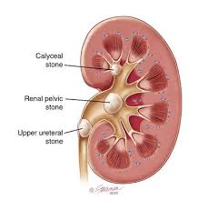Article On The Kidney Stone Remedy Report Http Www Kidneypaincures Com Kidney Stone Remedy Report Kidney Stones Symptoms Kidney Biopsy Kidney Stones Remedy