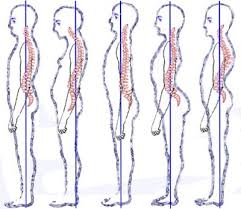 Low Back Pain Related To Hyperlordosis Physiopedia