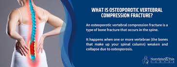 Image result for Vertebral Compression Fracture