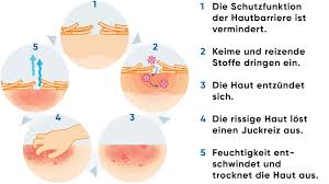 Image result for Neurodermatitis