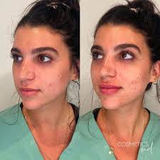Dermal Fillers