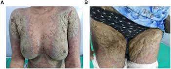 Image result for scabies norvegica