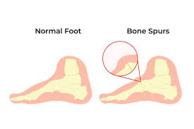 Bone Spur on Top of Foot: Causes, Signs, and Best Treatment Options