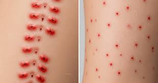 Image result for flea bites