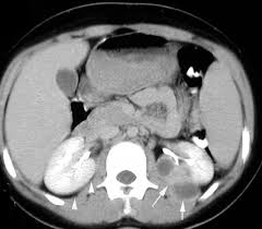 Image result for Perinephric Abscess