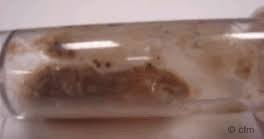 In the presence of this form, one should always exclude concomitant histoplasmosis. Fungal Disease Cystic Fibrosis Medicine