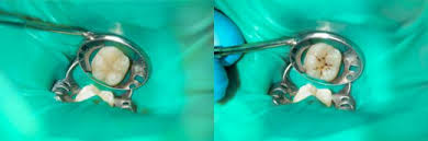 We did not find results for: Kompositfullung Kosten Preisbeispiele Und Mehr