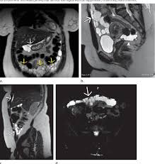 One study reported the mean age of female patients was 36. Benign Multicystic Peritoneal Mesothelioma 1 Semantic Scholar