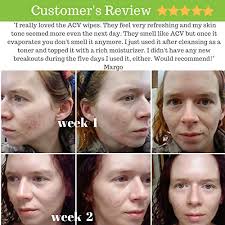 *sorry for all the silliness, i didn't get much sleep the night before.here it is! Apple Cider Vinegar Acne Face Toner Pads Organic Tea Tree Witch Hazel Rose Lavender Prevent Acnes Tone Hydrate Calm Sooth All Skin Types 60 Pads Usa By Hello Cider Pricepulse
