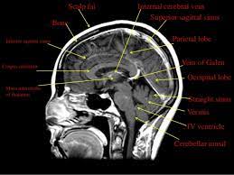 Mri Anatomy Of Brain Anatomy Drawing Diagram