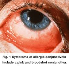 Image result for Allergic Conjunctivitis